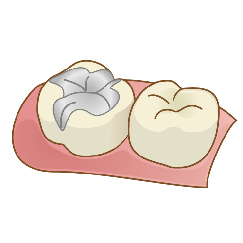 パラジウム合金