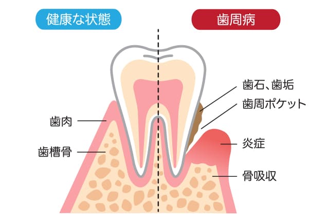 健康な状態と歯周病を比較したイメージ図